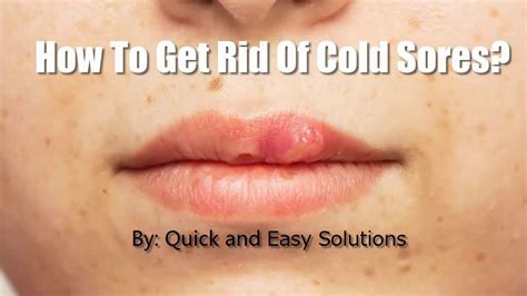 How To Get Rid Of Cold Sores Or Fever Blisters Naturally And Fast Youtube