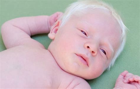 Albinizm Czym Jest Przyczyny Objawy I Leczenie Poradyfit Porn Sex