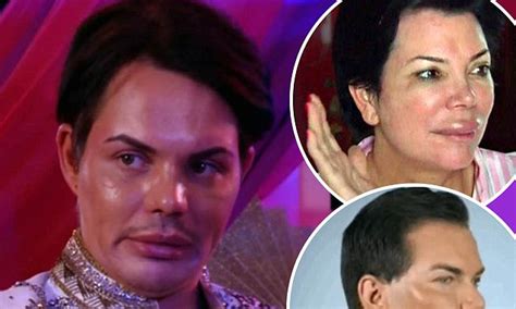 Towie S Bobby Norris Nose Job Divides Fans Daily Mail Online