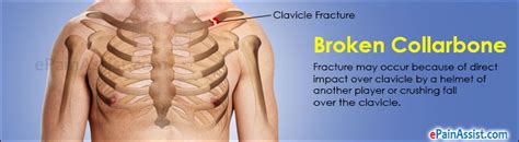 Broken Collarbone Or Clavicle Fracturecausessymptomstreatmentexercises