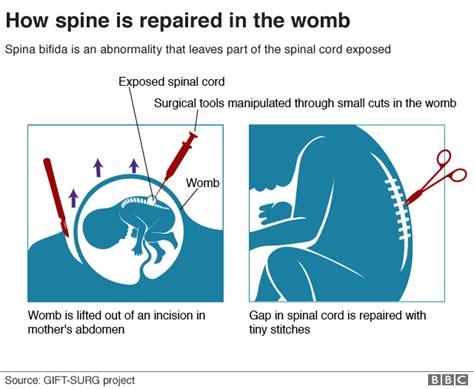 Two Unborn Babies Spines Repaired In Womb Myjoyonline Com
