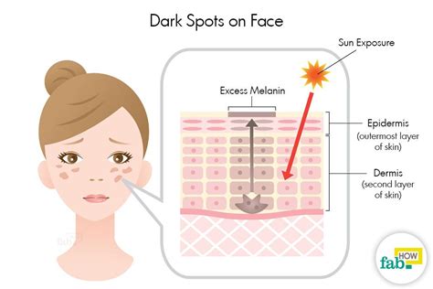 How To Get Rid Of Dark Spots On Face With Easy Home Remedies Lana