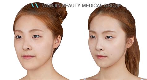 Korean Best Two Jaw Surgery Dentist Vs Plastic Surgery Wonjin