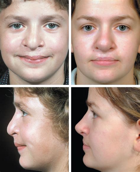 Definitive Rhinoplasty For Adult Cleft Lip Nasal Deformity Plastic