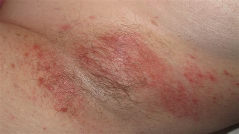 Breaking Out In Itchy Bumps Why A Skin Rash May Be A Coronavirus