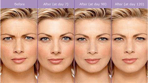 Botoxdysport Before And After The Beauty Clinic