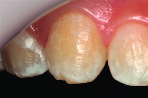 Initial Clinical Aspect Of The Lesion Of White Spot Lesion Tooth 13