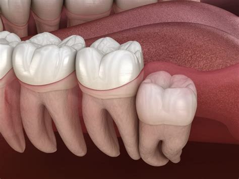 4 Types Of Wisdom Teeth Impactions Laurich Dentistry