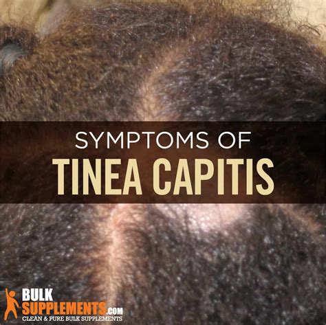 Tinea Capitis Ringworm Of The Scalp Causes Symptoms And Treatment