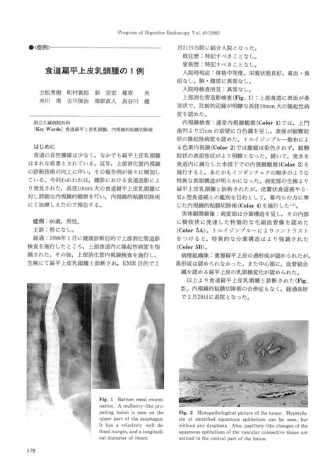 PDF A Case Of Squamous Cell Papilloma Of The Esophagus