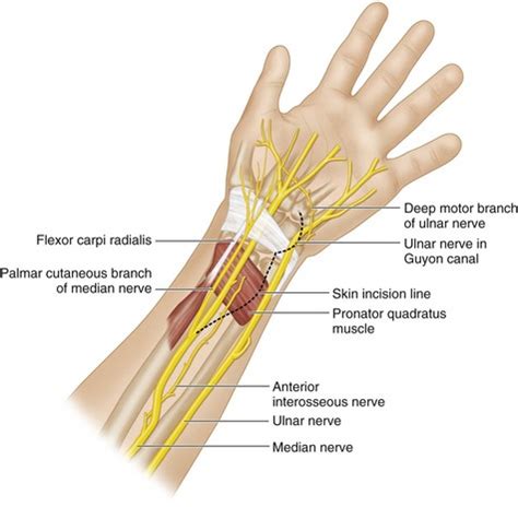 14 Distal Anterior Interosseous Nerve Transfer To Motor Branch Of