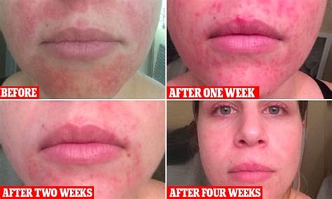 Woman Claims That Raw Honey Cleared Her Acne Daily Mail Online