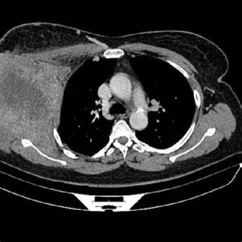 Thoracic Ct In Cross Section After Injection Of Contrast Medium Showing