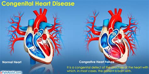 Congenital Heart Diseasecausessymptomstreatment
