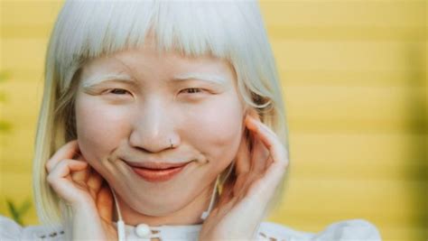 International Albinism Awareness Day 2021 What Causes Albinism Types