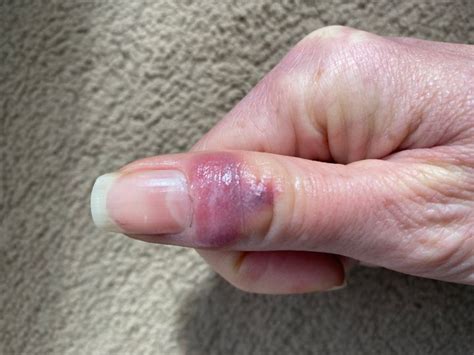 9 Photos Showing What Covid Fingers And Toes Can Look Like Huffpost
