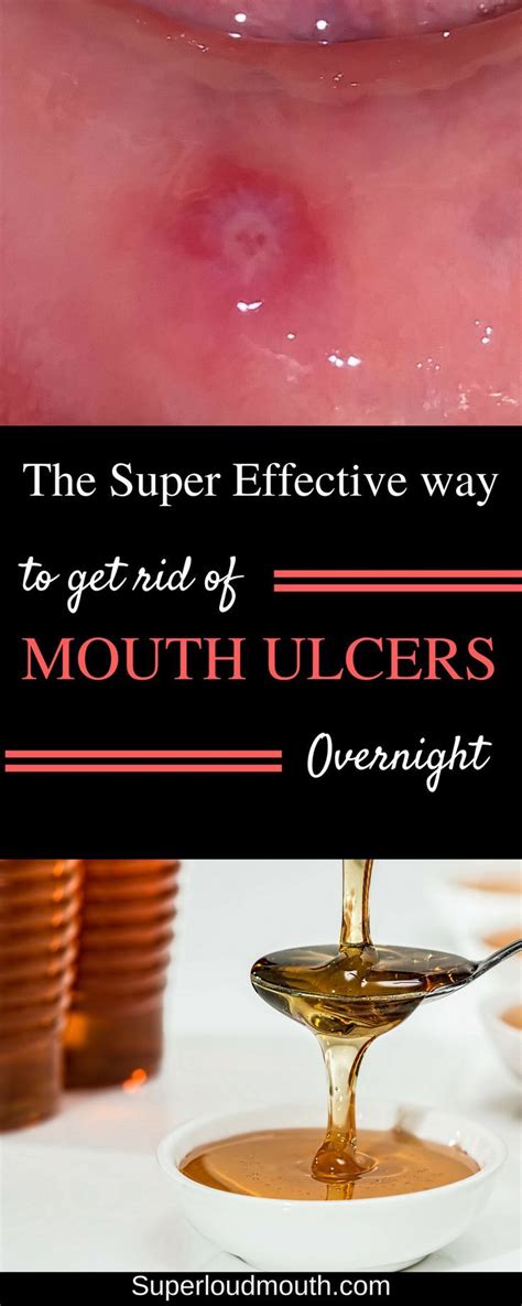 31 Home Remedies To Get Rid Of Mouth Ulcerssores Sore In Mouth