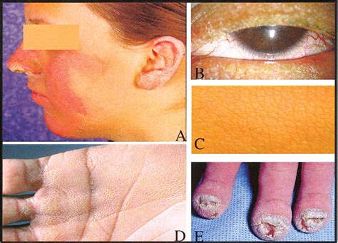 Pain, impaired eyesight, photophobia (light sensitivity). Deafness-ichthyosis-keratitis syndrome. Causes, symptoms ...