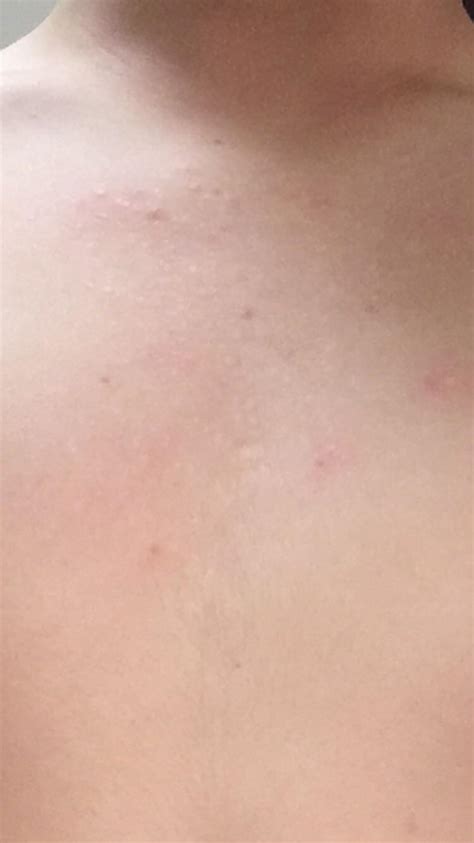 White Bumps On Chest