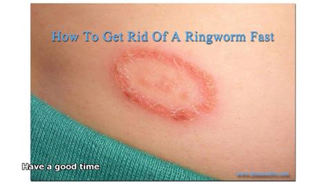 Cause Of Ringworm Youtube