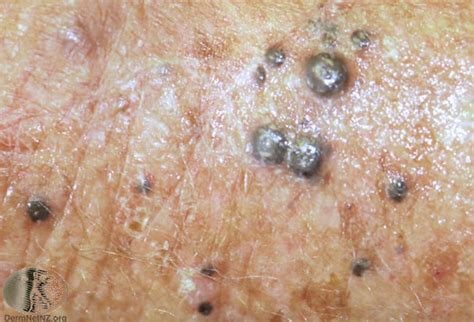 Deadly Skin Cancers You Need To Know