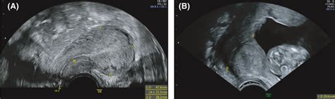 Transvaginal Sonographic Imaging Of The “neo‐cervix” A Transvaginal Download Scientific