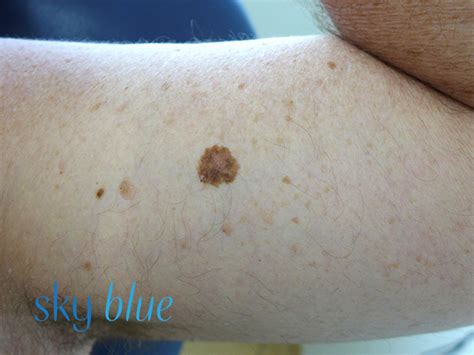 Skin Cancer What You Need To Know And A Bit More Sky Blue Dermatology