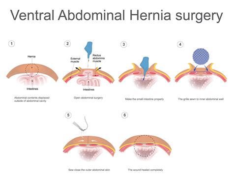 Umbilical Hernia Repair Hernia Mesh Pictures Umbilical Hernia Repair Surgery Stock Photo