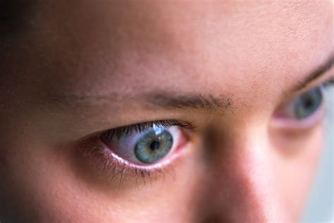 Macro Closeup Profile Portrait Of Young Woman Face With Graves Disease