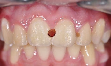 Odontología Caries Interproximal
