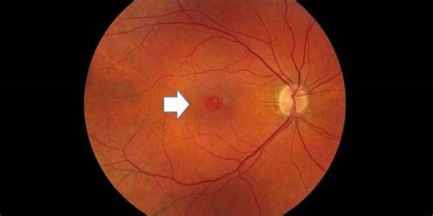 Understand The Symptoms Causes Treatment Of A Macular Hole
