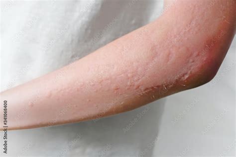Skin Rashes Allergies Contact Dermatitis Stock Photo Adobe Stock