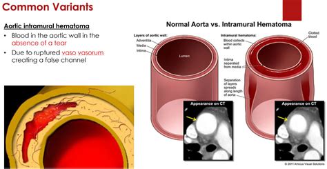 Aortic Dissection 02202018 Scvmc Im Chief Resident Blog