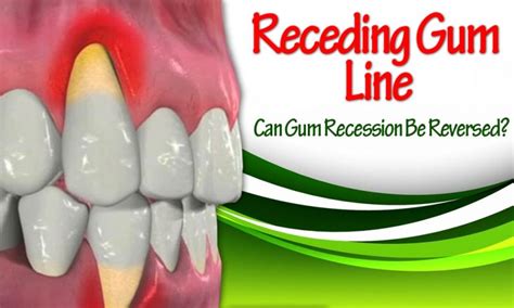 Gum Recession Facts And Advice Oramd Blog