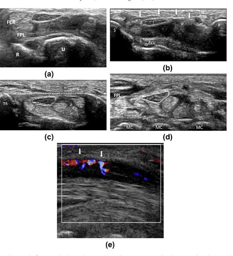 Ultrasound Carpal Tunnel Syndrome Additional Criteria For Diagnosis