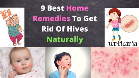 How To Cure Hives Naturally 9 Best Home Remedies Youtube