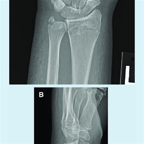 A Distal Radius Fracture Posteroanterior Radiograph Demonstrates