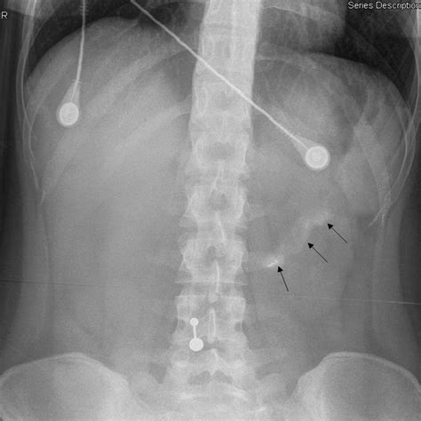 Abdominal Radiograph Performed At 6 H Post Ingestion Radioopaque