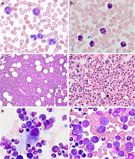 Abnormal Morphological Features Observed In Chronic Eosinophilic