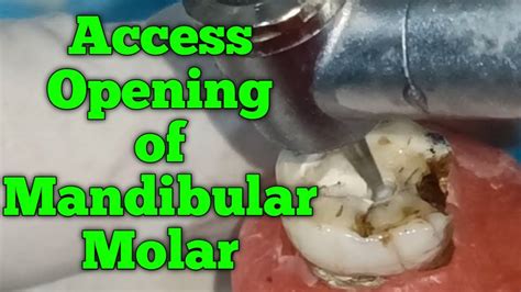 Access Opening Of Mandibular First Molar First Step Of Rct Youtube