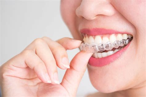 What Are Invisalign Attachments Smile Stories