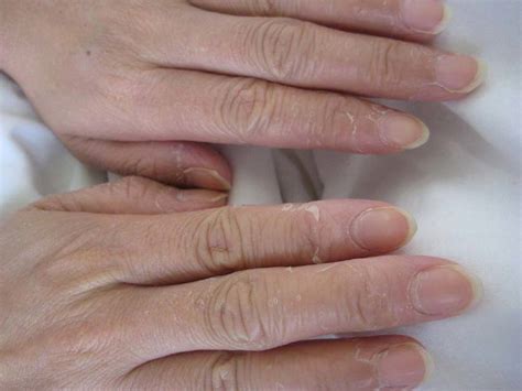 Case 2 Peeling Of The Fingertips Download Scientific Diagram