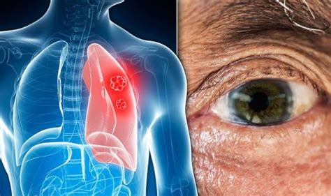 Lung Cancer Symptoms Signs Of A Tumour Include Yellow Eyes And