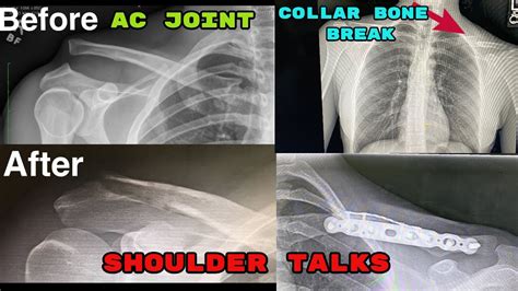 Part 3 Pain Tolerance After Shoulder Surgery Ac Joint Separation
