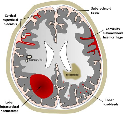 Sporadic Cerebral Amyloid Angiopathy Revisited Recent Insights Into