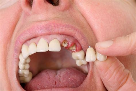 Use These Easy Tips When Seeking Wisdom Teeth Removal In Burlington
