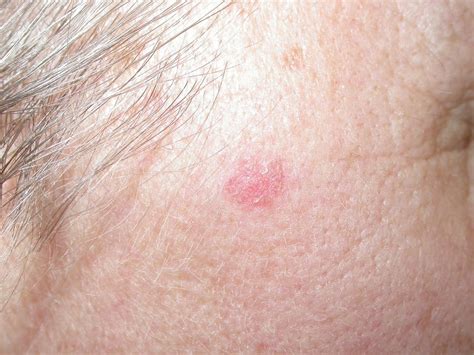 Basal Cell Carcinoma Definition Examples And Forms Kulturaupice