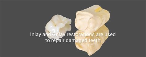 Dental Inlay And Onlay Treatment At Mayfield Dental South Croydon
