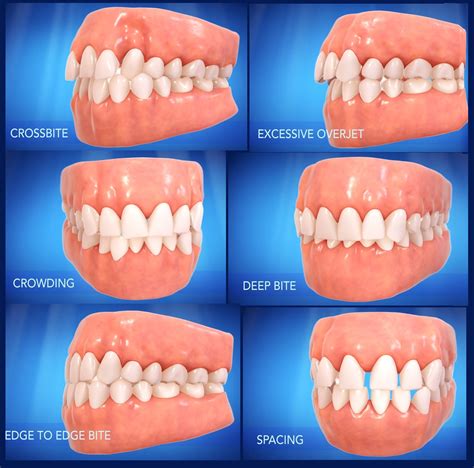 Invisalign Candidate1 Archer Dental