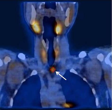 Ectopic Thymic Parathyroid Adenoma Bmj Case Reports